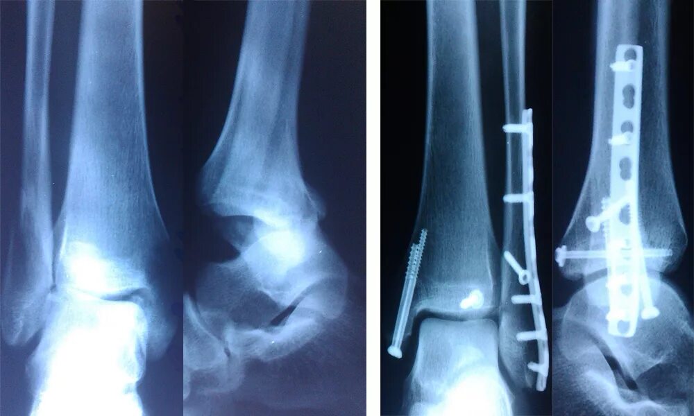 Перелом со смещением нужна операция. Перелом лодыжки с остеосинтезом. Остеосинтез перелома Дюпюитрена. Внутрикостный остеосинтез лодыжки. Экстрамедуллярный остеосинтез голени.