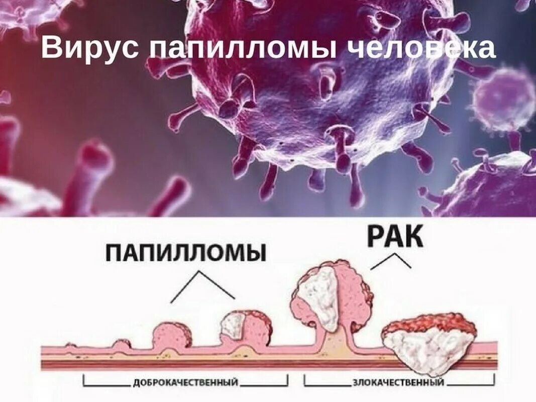 Мироспопилома человека. Вируспаппиломы человека. Вирус попиломычелоаека.