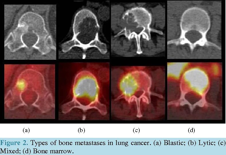 Вторичное поражение костей. Позитронно-эмиссионная томография метастазы. ПЭТ кт метастазы в костях.