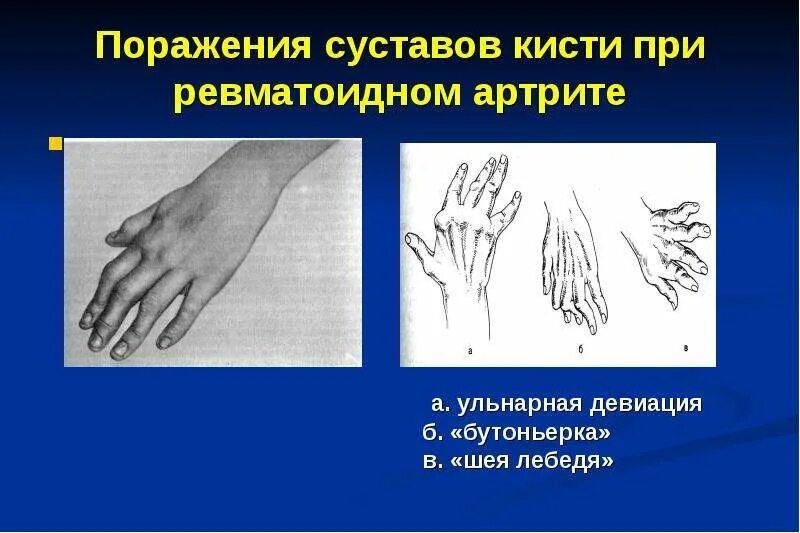 Деформации кисти при артритах. Ульнарная девиация кисти. ульнарная девиация при ревматоидном. деформации суставов пальцев ревматоидный артрит. ульнарная девиация при артрите.