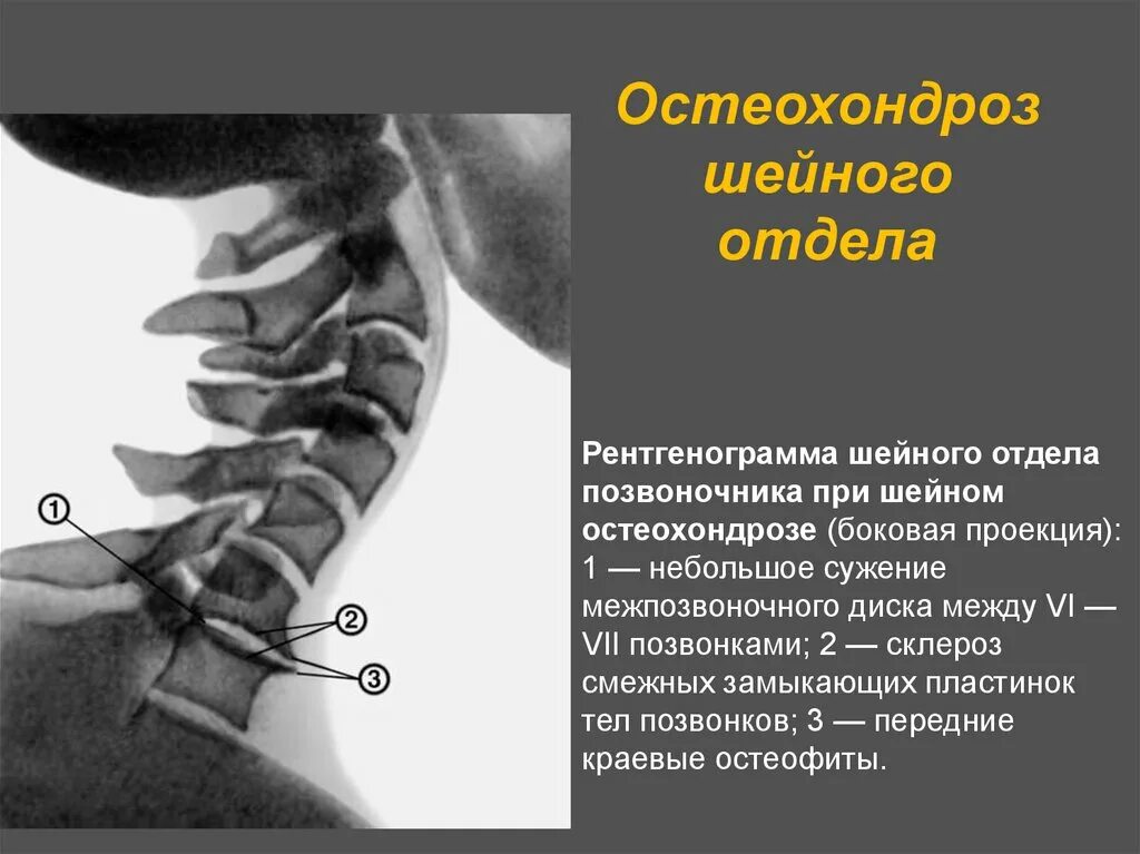 Остеохондроз шейного отдела позвоночника. Остеохондроз шейного позвонка. Шейный отдел позвоночника при остеохондрозе. Шейные позвонки при остеохондрозе.