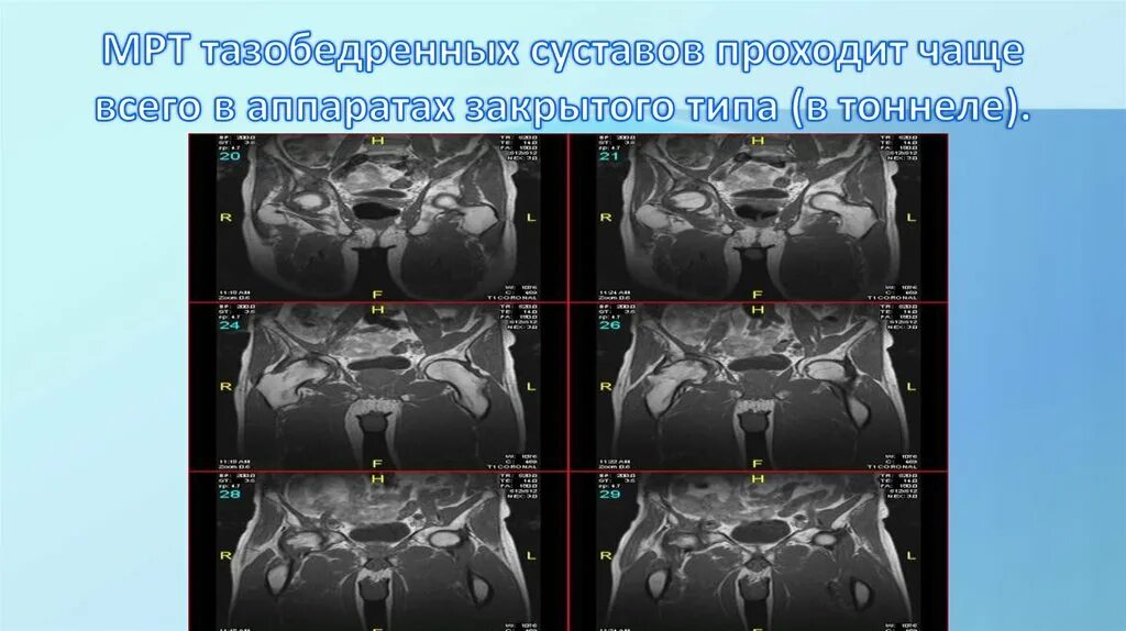 Мрт тазобедренного сустава в минске. Протокол мрт тазобедренного сустава. дисплазия тазобедренных суставов мрт. мрт тазобедренного сустава. дисплазия тазобедренных суставов мрт протокол.