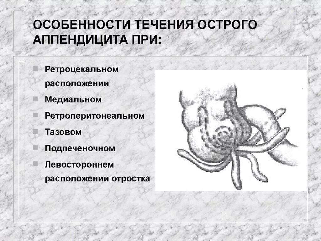 Локализация острого аппендицита. Ретроцекальное положение аппендикса. Ретроцекальный аппендицит расположение. Острый аппендицит локализации отростка. Ретроцекальное расположение аппендикса.