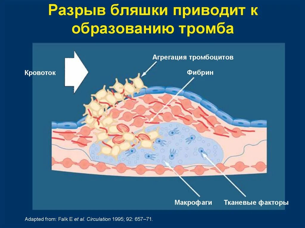 Разрыв атеросклеротической бляшки патогенез. Разрыв капсулы атеросклеротической бляшки. Разрыв холестериновой бляшки. Причины отрыва атеросклеротической бляшки. Образование тромба попадание факторов