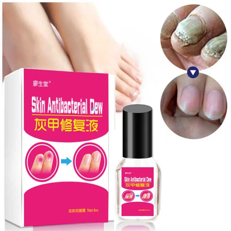 Китайское средство от грибка ногтей Nail fungus. Китайское средство от грибка fungal Nail treatment. Китайский крем от грибка ногтей Nail fungus. Китайская эссенция от грибка ногтей. Лечения грибка ногтя маслом