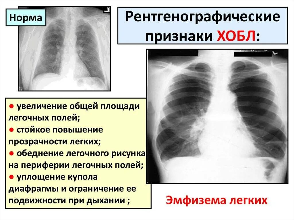 Какие легкие в норме. Рентген при ХОБЛ эмфизема. Хронический обструктивный бронхит рентген. Рентген грудной клетки ХОБЛ. Рентгенография лёгких при ХОБЛ.