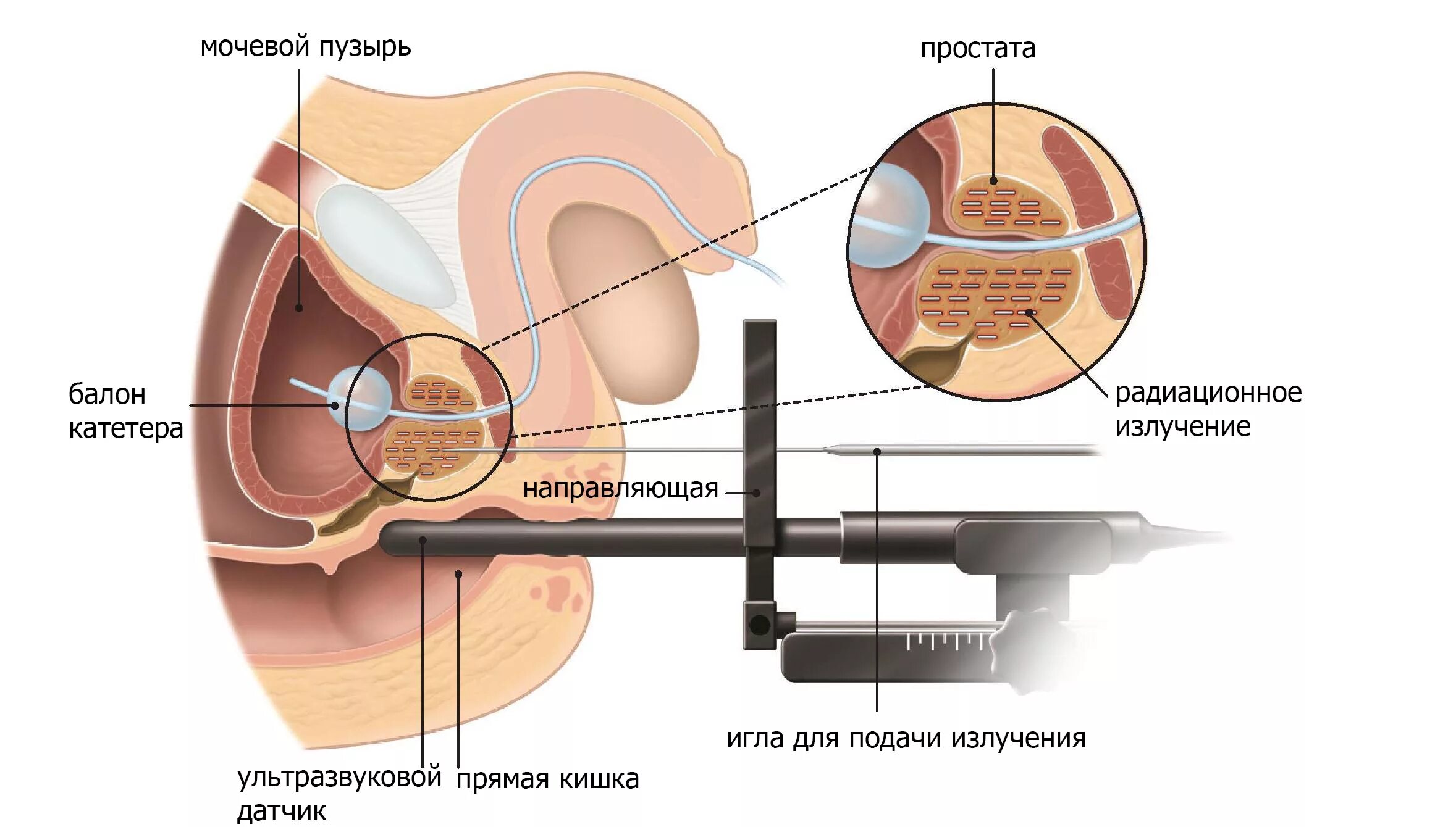 Лучевая терапия опухоли предстательной железы. Дистанционная лучевая терапия предстательной железы. Внутриполостная лучевая терапия предстательной железы. Лучевая терапия при онкологии брахитерапии.