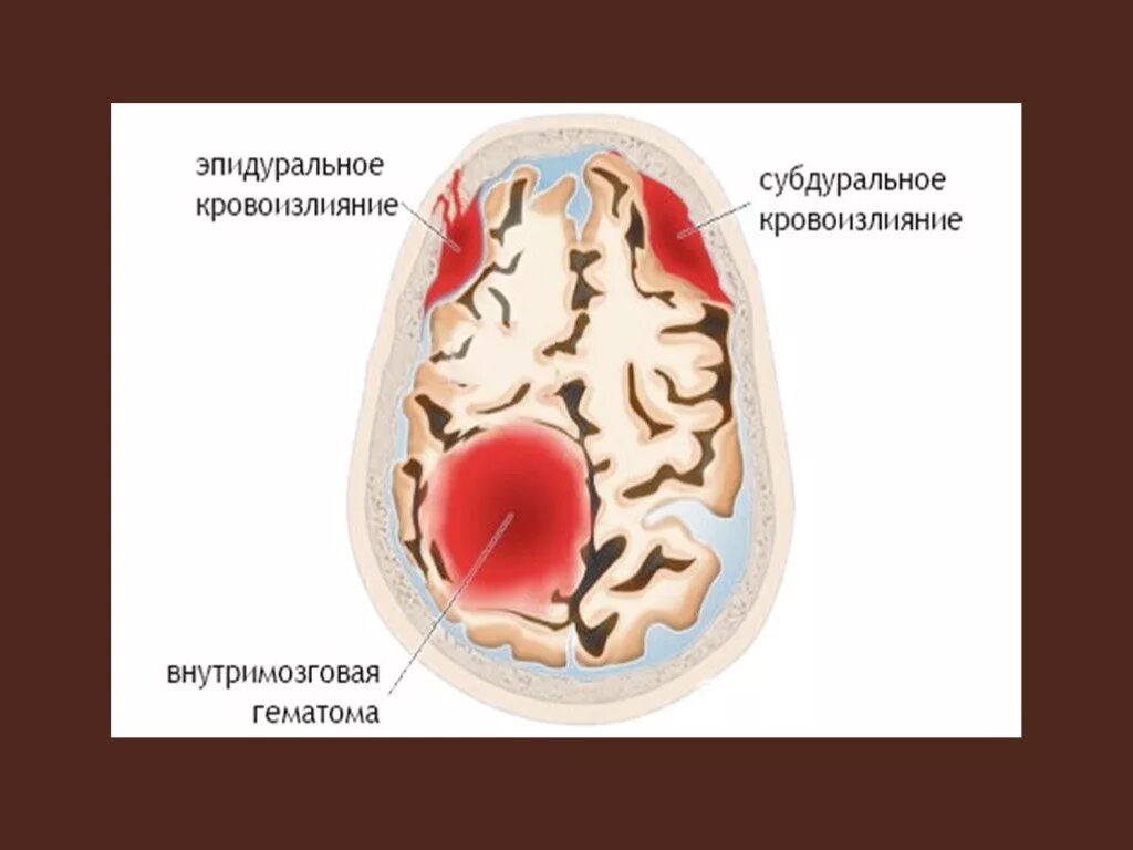 Субдуральная кровоизлияние. Внутричерепное кровоизлияние. Субдуральное и субарахноидальное кровоизлияние. Эпидуральные кровоизлияния.