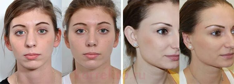 Как сделать чтобы уши не торчали