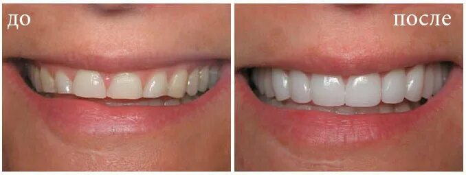Эстетическое наращивание зубов. Эстетическая реставрация передних зубов. Реставрированные передние зубы. Наращивание зубов композитными материалами.