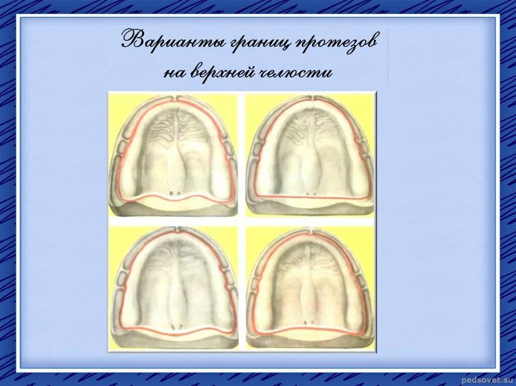 Зона податливости слизистой оболочки. Зоны податливости по Люнду. Зоны податливости слизистой оболочки по Люнду. Фиброзная зона по Люнду. Классификация по Люнду.