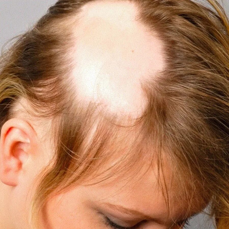 Причины выпадения волос у подростка. Гнёздная (очаговая алопеция). Очаговая алопеция (alopecia Areata). Гнёздная очаговая алопеция у детей.