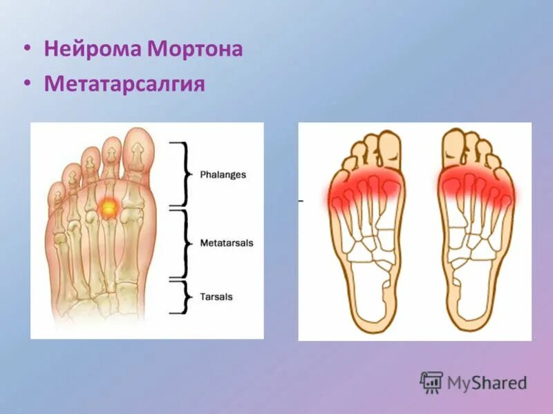 Нейрома примеры. Педиатрическая обувь.