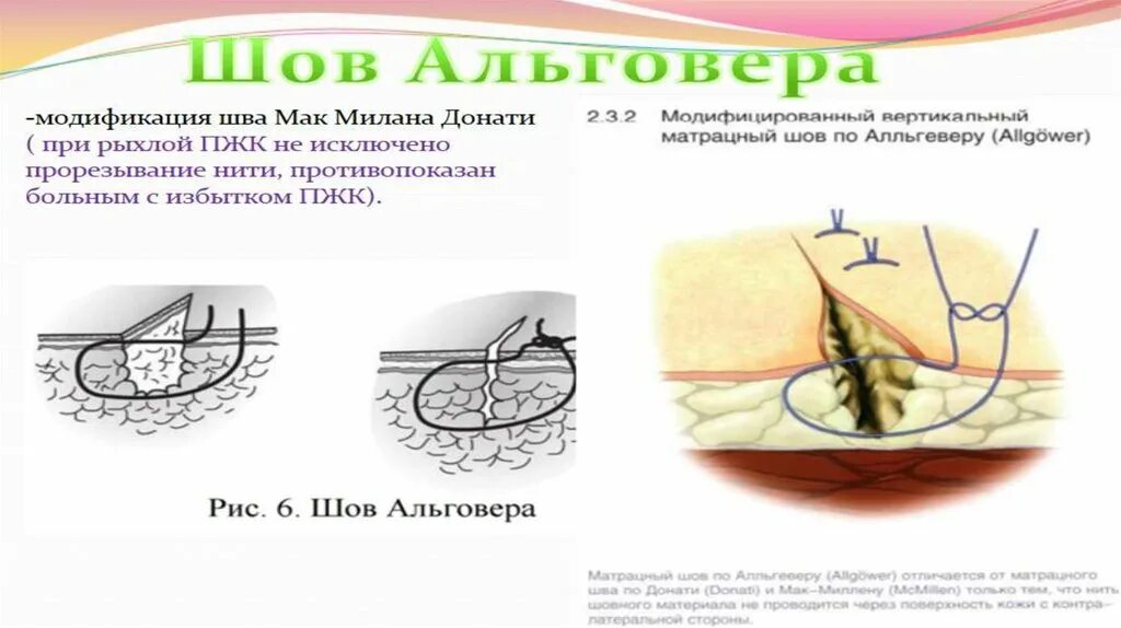 Внутрикожный узловой шов. Матрацный шов в хирургии. Косметический шов внутрикожный. Простой узловой шов хирургия. Ли шов.