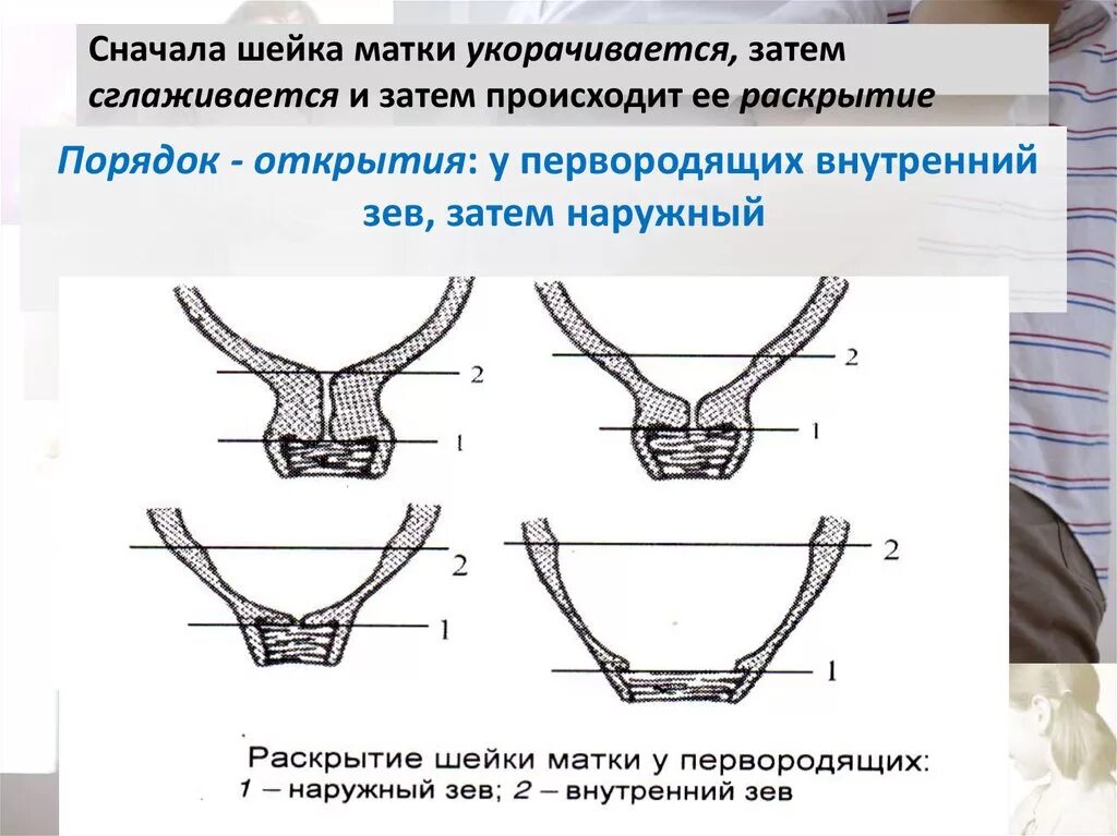 Раскрытие 1 палец через. Раскрытие шейки матки у первородящих. Раскрытие внутреннего зева. Раскрытие шейки у первородящей.