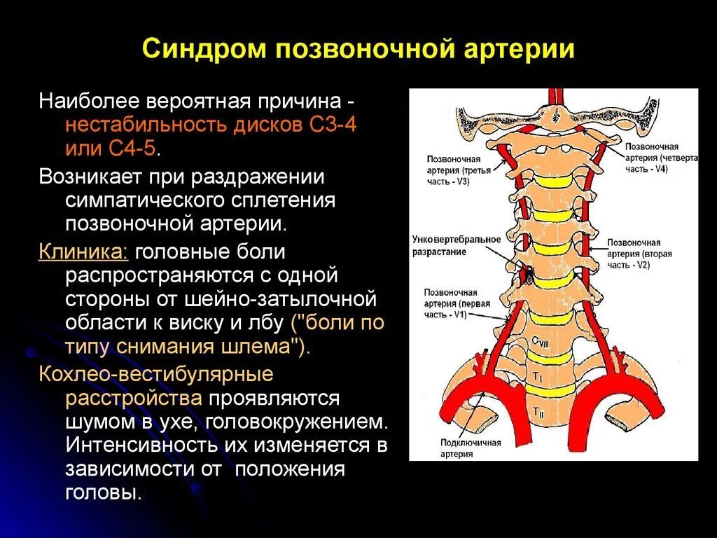 Почему горит шея. Шейный остеохондроз позвонки шейного отдела. Синдром позвоночной артерии с4. Вертебральный синдром позвоночной артерии. Синдром позвоночной артерии вертебро-базилярная недостаточность.