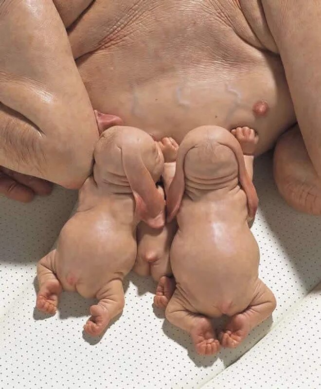 Micropenis