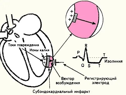 Субэндокардиальный инфаркт