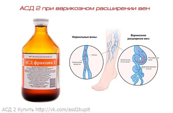 Можно ли пить асд 2 фракция. Асд вторая фракция. асд2 при варикозе. асд-фракция 2 при варикозе. фракция асд-2 при гинекологии.