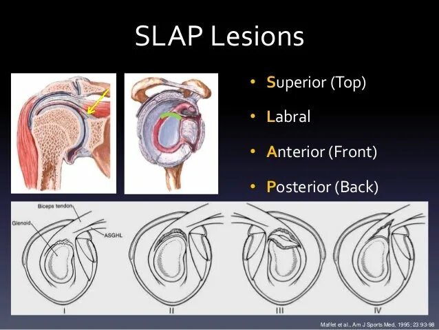 Классификация slap повреждения. Slap повреждение плечевого сустава на мрт.