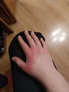 От холода опухают