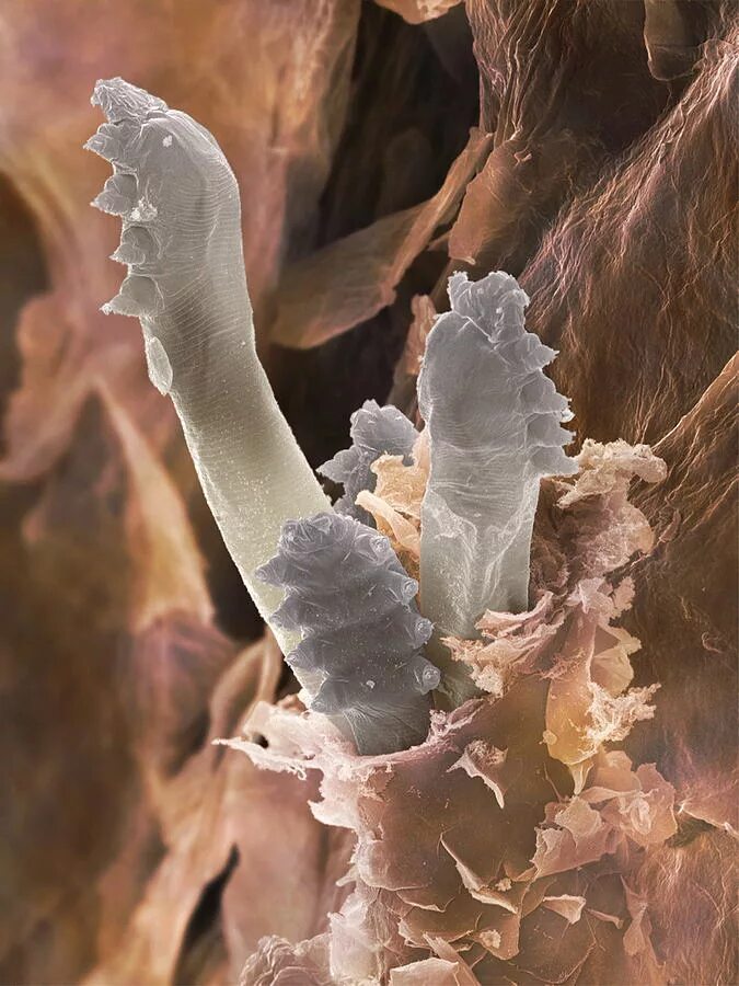 Демодекс микроскоп. Демодекоз (угревая железница). клещ demodex folliculorum микроскоп. железница угревая - клещ паразитология.