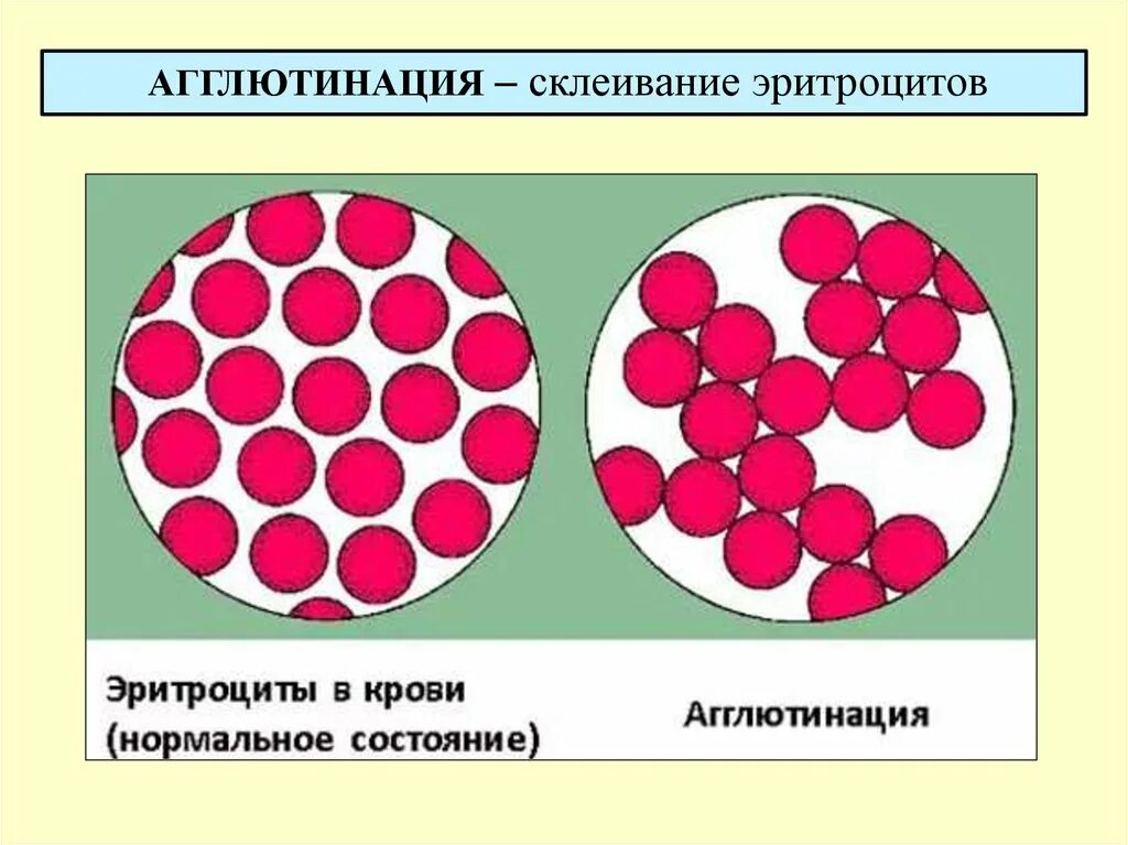 Агглютинация эритроцитов. Склеивание эритроцитов – агглютинация. агглютинация реакция склеивания эритроцитов. реакция агглютинации при переливании крови. агглютинация эритроцитов рисунок.