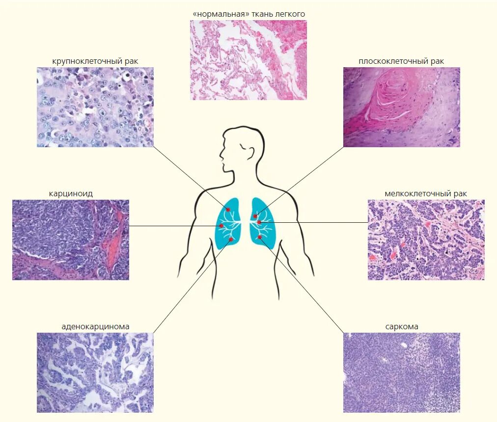 Плоскоклеточная карцинома легкого гистология. Гистологическая классификация опухолей легких. Плоскоклеточная карцинома легкого микропрепарат. Нейроэндокринная карцинома гистология. Лечение мелкоклеточного рака