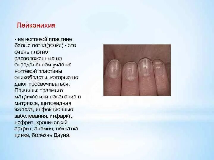 Белые полоски на ногтях причины у женщин. Заболевания ногтей на руках таблица. заболевания по ногтям рук. распространённые болезни на ногтях. заболевания по форме ногтей.