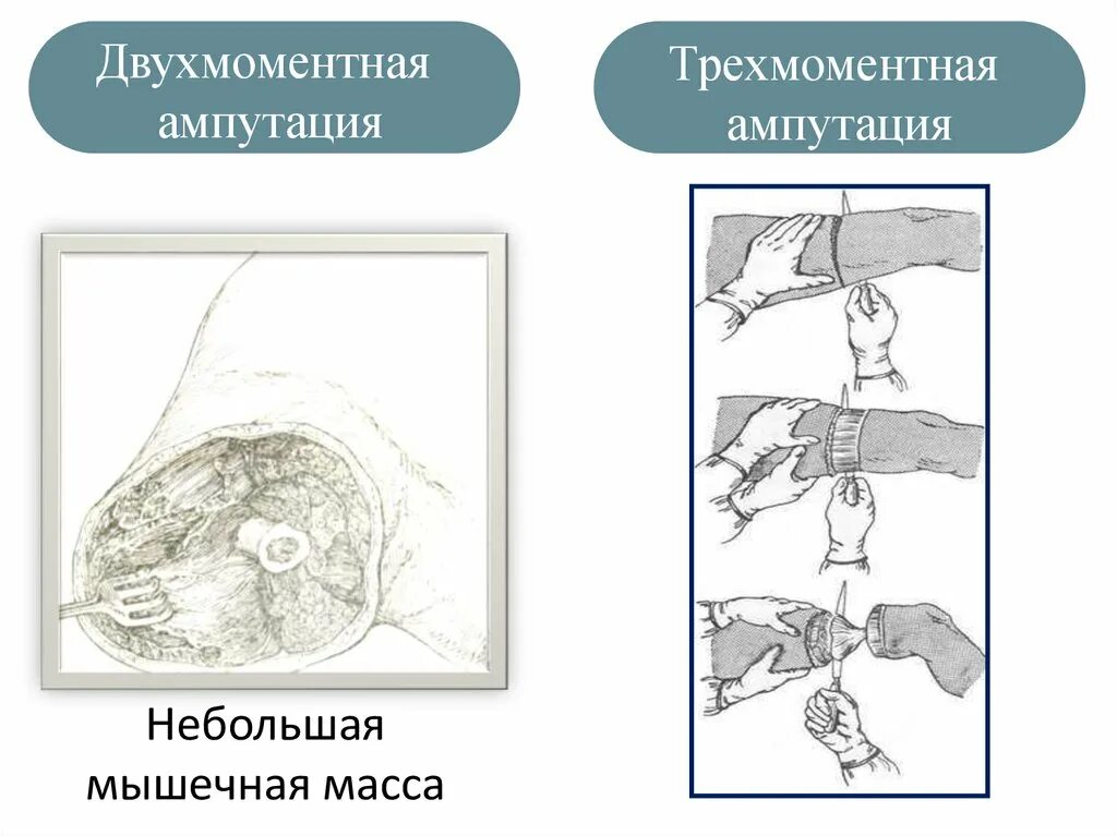 Конусо круговая ампутация бедра по Пирогову. Трехмоментная конусно-круговая ампутация по Пирогову. Трехмоментная конусно-круговая ампутация бедра.