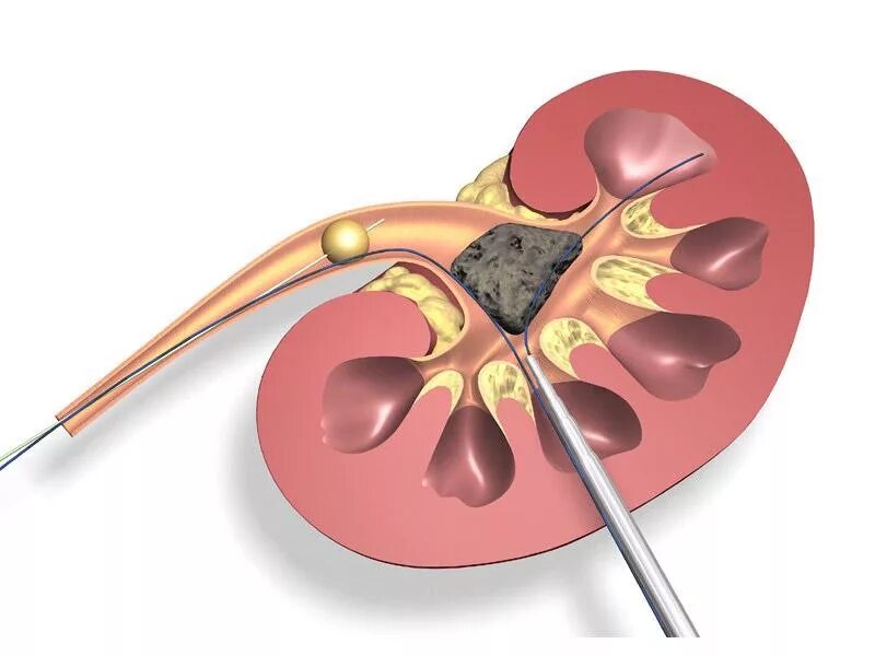 Трансуретральная нефролитолапаксия. Перкутанная нефролитотрипсия. Чрескожная нефролитолапаксия. Нефролитотрипсия перкутанная лазерная. Как вывести камни без операции