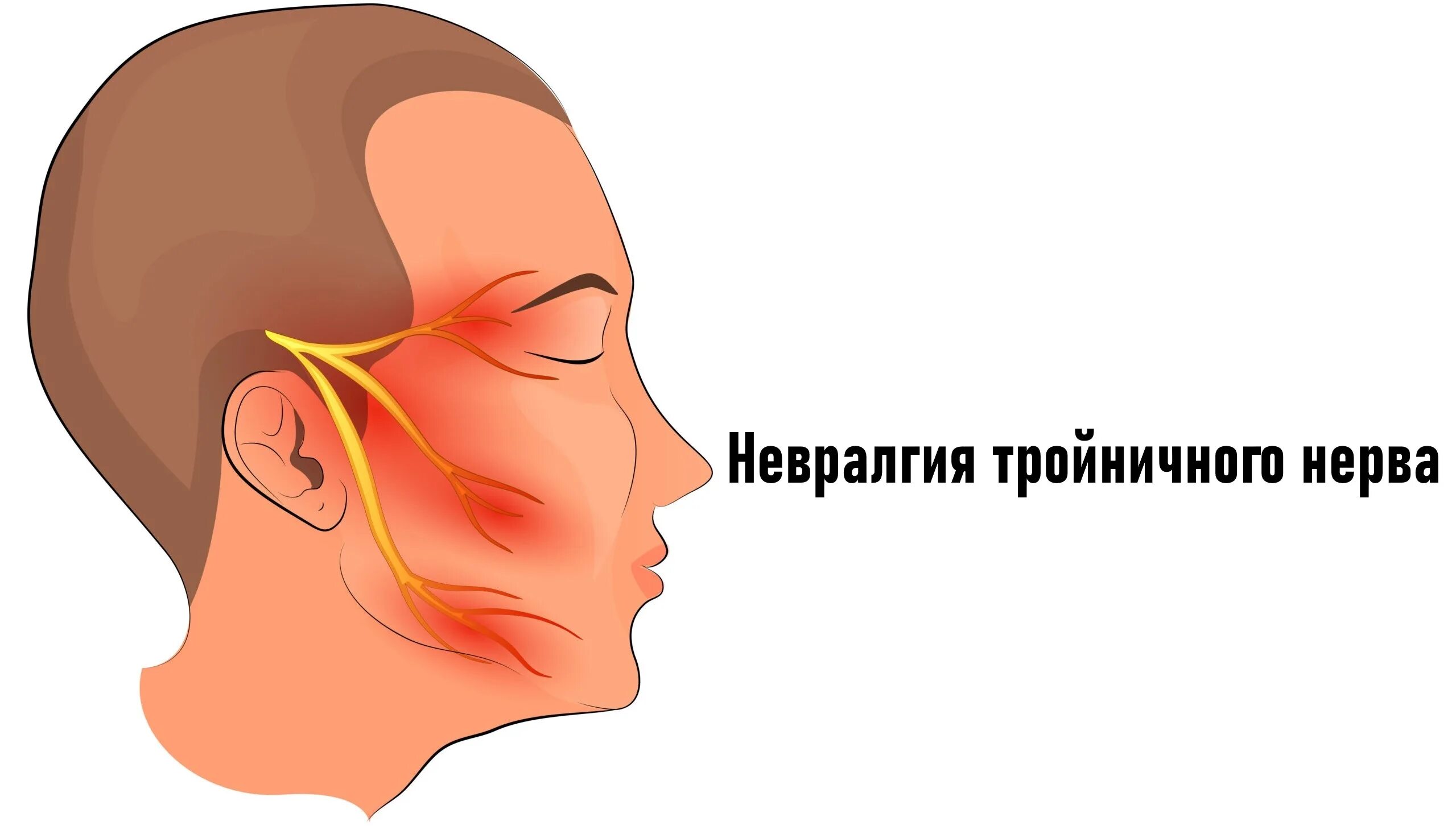 Онемевает правая сторона лица. Воспаление тройничного нерва. Воспаление лицевого нерва. Trigeminal Neuralgia. Неврит и невралгия тройничного нерва.