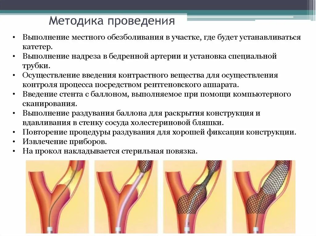 Стент после операции. Стентирование коронарных артерий методика. Ангиопластика сосудов нижних конечностей. Стент в бедренной артерии. Стентирование артерии показания.