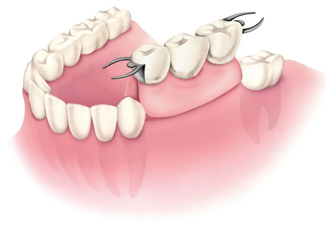 Зубной мост мостовидный протез. Мостовидный протез 3 ед МК что это. Мостовидный зубной несъемный протез. Мостовидный протез на 1 зуб. Сена зуб