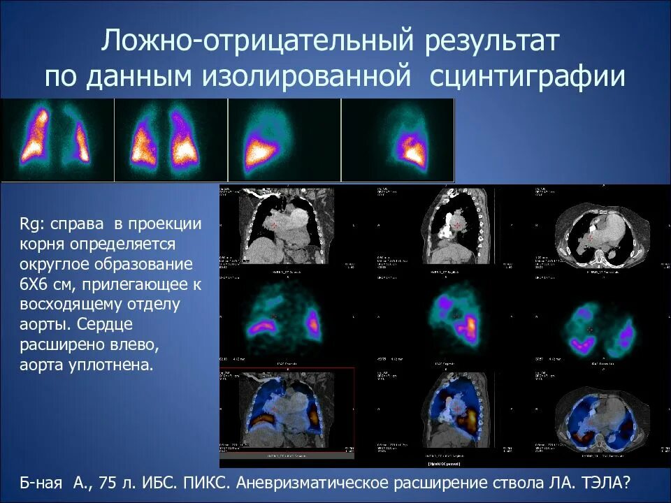 Ложно отрицательный результат. Сцинтиграфия ОФЭКТ кт легких. Сцинтиграфия метастазы очаг. Сцинтиграфия с ОФЭКТ кт. Однофотонная эмиссионная томография миокарда.