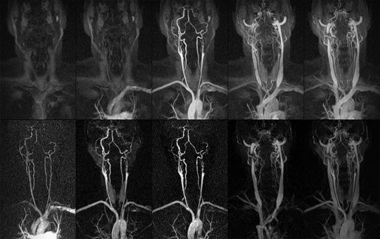 Венография головного мозга. Мрт ангиография сосудов шеи. Кт ангиография сонных артерий. Кт ангиография интракраниальных артерий. МР-ангиография интракраниальных сосудов.