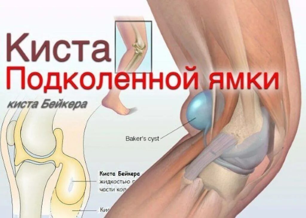 Киста Бейкера коленного сустава. Киста подколенойямки. Синовиальная киста коленного сустава.