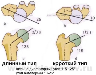 Шеечно диафизарный угол у детей норма таблица