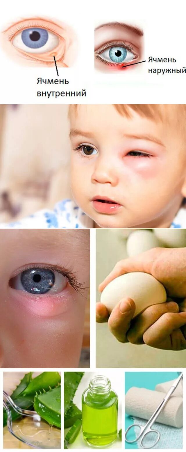 Ячмень лечение домашними средствами. Ячмень на глазу уребегка. Ччиннь на глазу у детей.