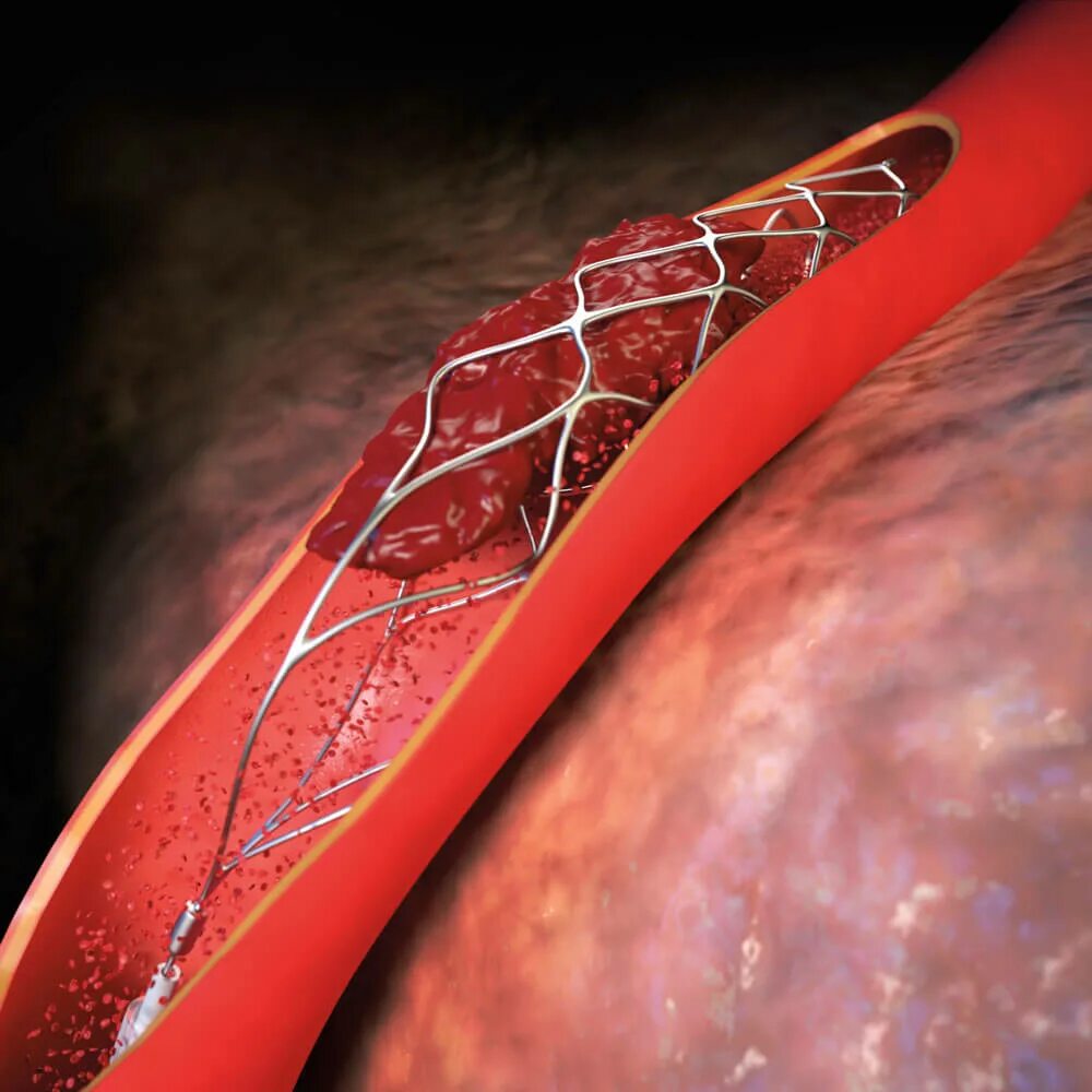 Тромбоэмболия артерий нижних