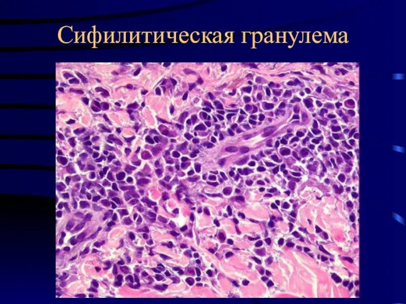 Кишечные инфекции патологическая анатомия. Стадия мозговидного набухания брюшной тиф. Мозговидное набухание пейеровых бляшек при брюшном тифе. Некроз пейеровых бляшек при брюшном тифе микропрепарат. Кишечные инфекции патологическая анатомия.