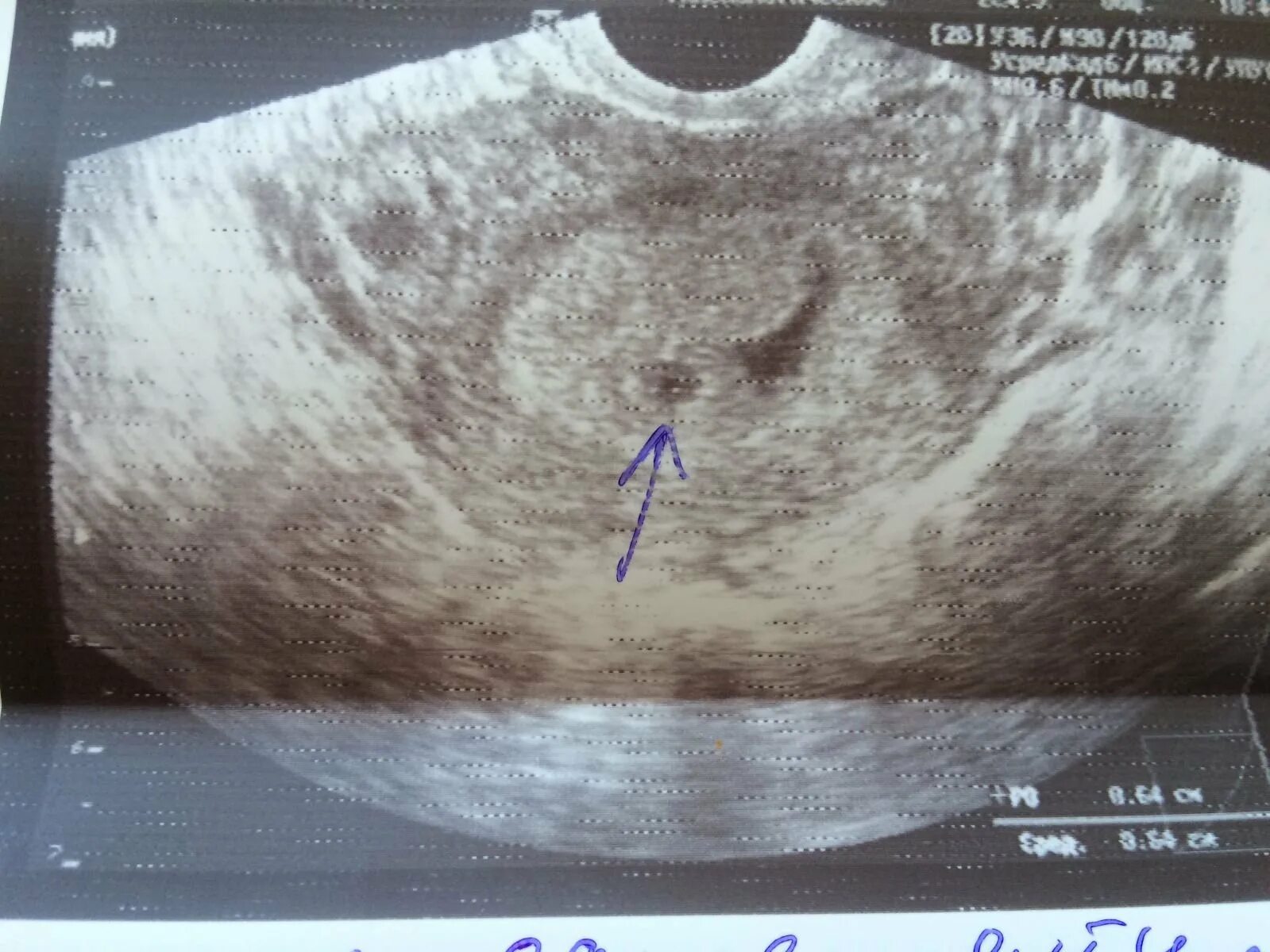 Эмбрион 2-3 недели УЗИ беременности. УЗИ беременности 2.5 недели. УЗИ плодное яйцо 2 недели. Беременность на 2-3 недели беременности на УЗИ.