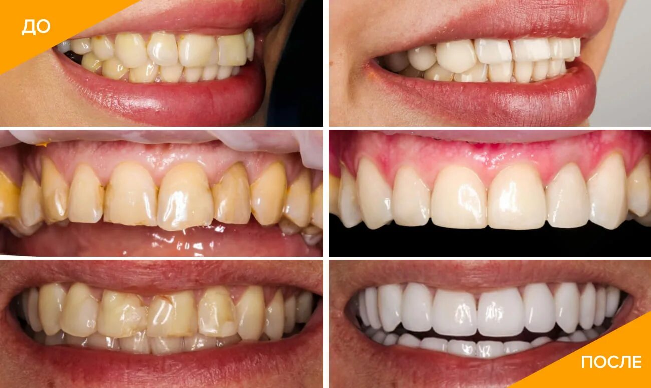 Виниры на зубы на кривые зубы. Исправление зубов до и после. Установленных до и после