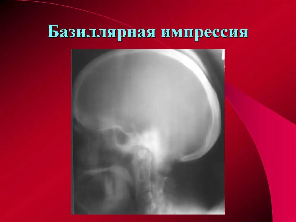 Импрессионный перелом мыщелка коленного сустава. Импрессия кости. Импрессионный перелом внутреннего мыщелка бедренной кости. Импрессия кости. Импрессия кости.
