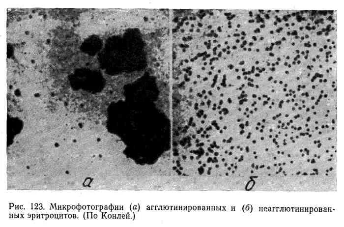 Холодовая агглютинация эритроцитов. Агглютинация эритроцитов. агглютинация эритроцитов под микроскопом. агглютинация эритроцитов причины. агглютинация эритроцитов под микроскопом фото.
