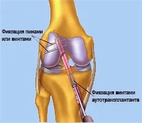 Операция на связки коленного сустава