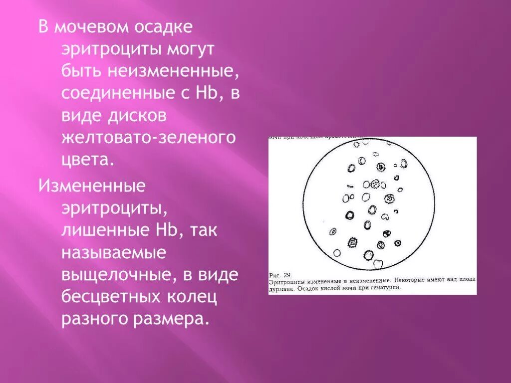 Сколько эритроцитов в моче. Измененные и неизмененные эритроциты в микроскопии мочи. Эритроциты выщелоченные микроскопия. Эритроциты в мочевом осадке норма. Выщелоченные эритроциты в моче.