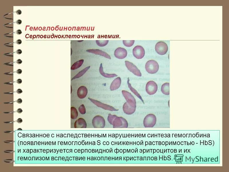 Серповидноклеточная анемия рецессивный