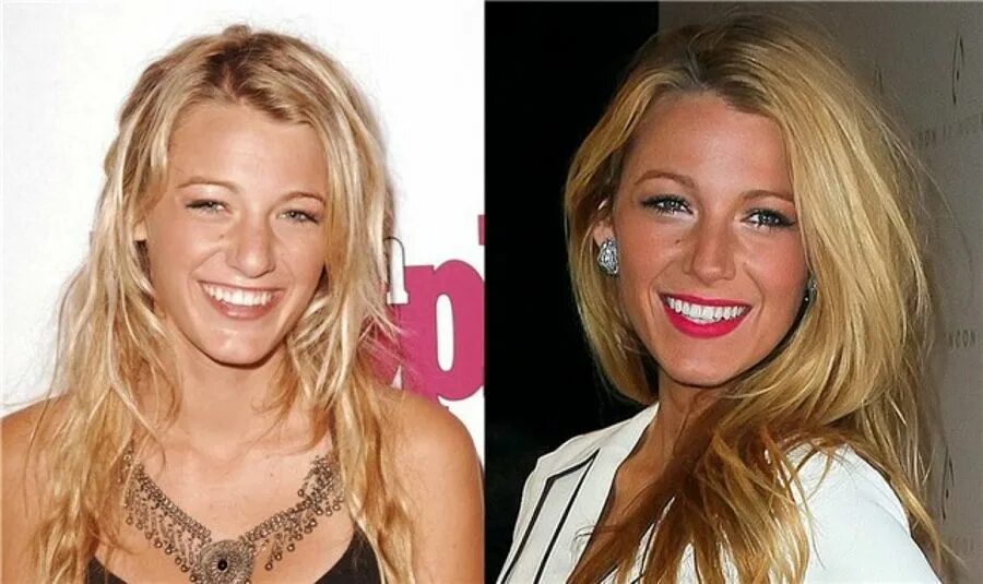 Блейк лайвли операция нос. Блейк лайвли ринопластика. Блейк лайвли до и после операции. Блейк лайвли нос. Блейк лайвли до и после операции.