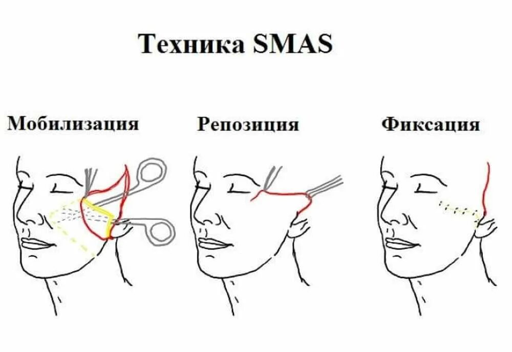 Схема подтяжки лица. Круговая подтяжка лица схема операции. Смас лифтинг схема операции. Смас подтяжка схема.